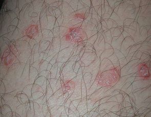 牛皮癣 牛皮癣